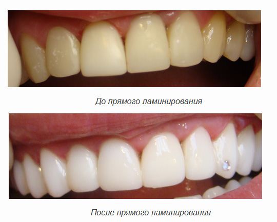 Ламинирование зубов в Кемерово